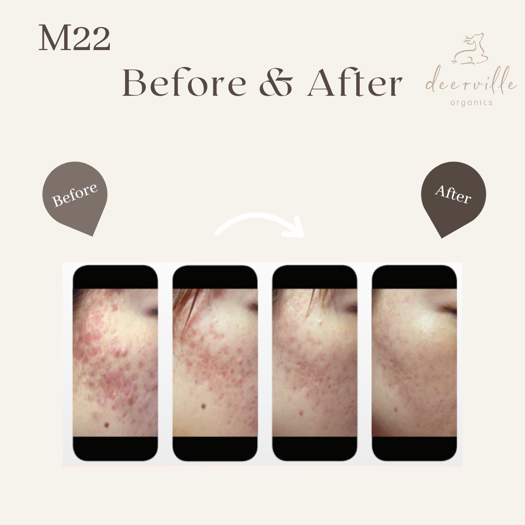 M22光子嫩膚二重奏