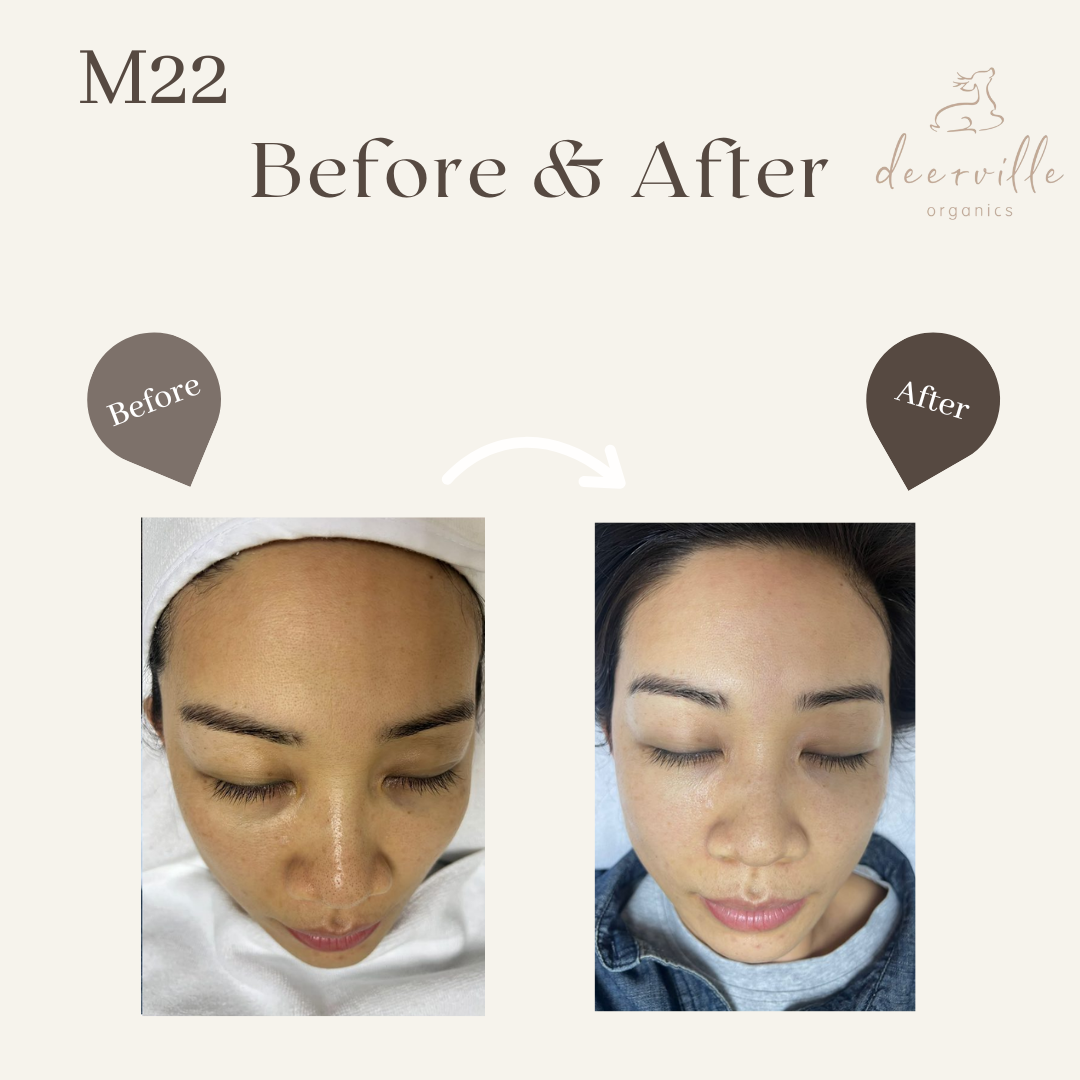 M22光子嫩膚