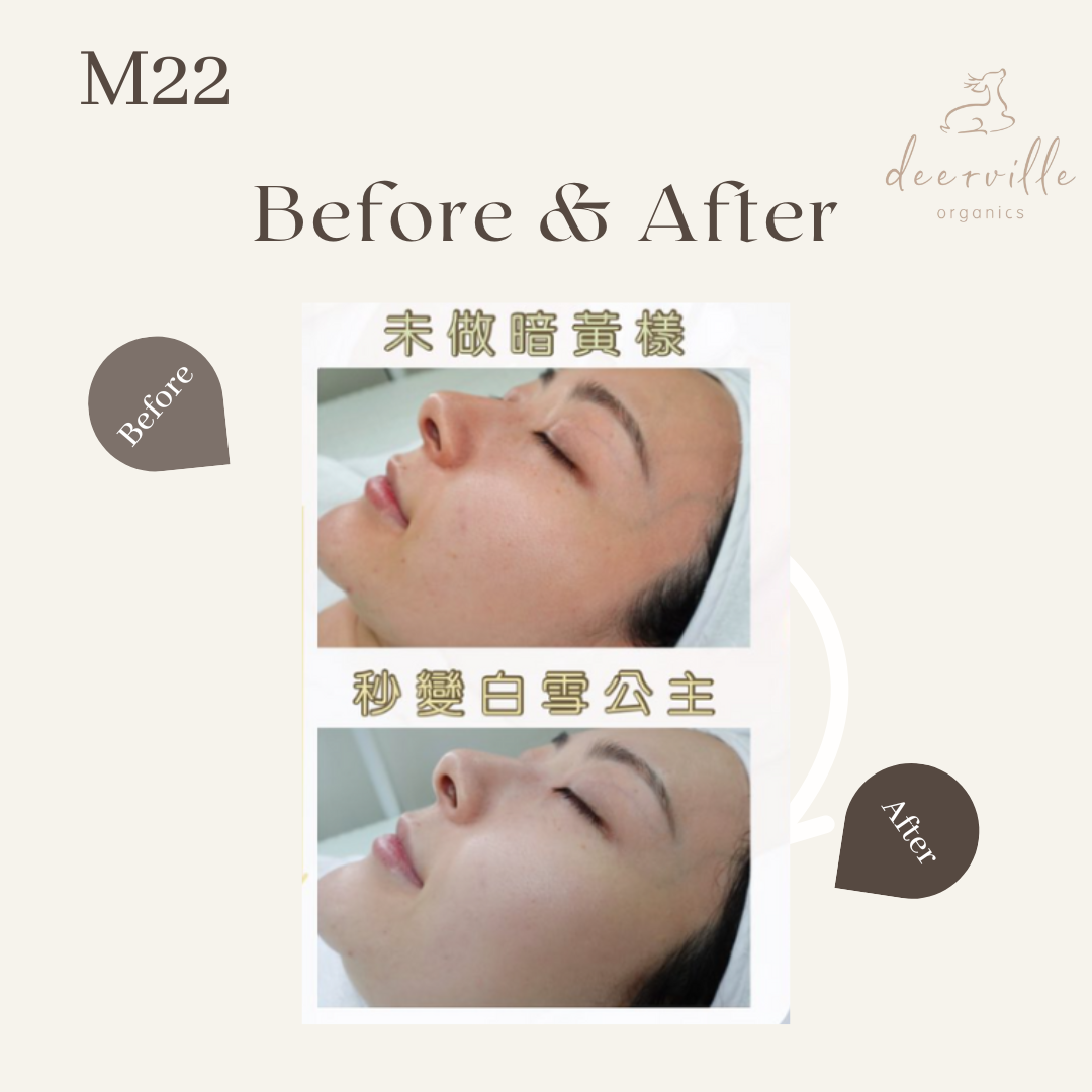 M22光子嫩膚